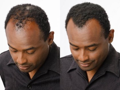 Görünür Saçlar - Sarı-İnceltme, Seyrek veya Saçsız Alanları doldurmak için 25 Gram Saç Yapı Elyafları-Mevcut saçlara tespit edilemeyen